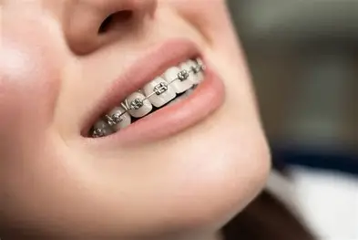 Braces Overview
